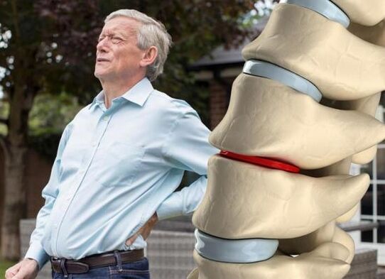 Osteoxondroz intervertebral disklarga ta'sir qiladi va bel og'rig'iga sabab bo'ladi