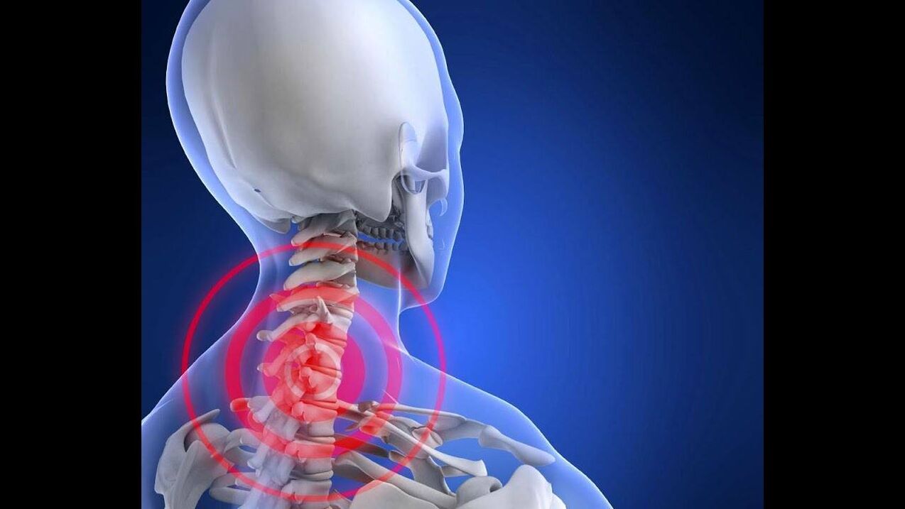 Servikal umurtqa pog'onasining osteoxondrozi